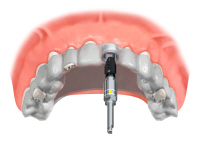 navigált implantáció