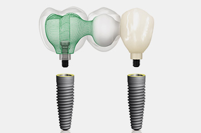 implant2
